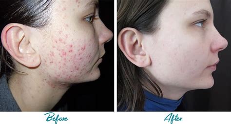 patient 18616220 acne scars before and after photos alinea medical spa acne scar and laser skin care