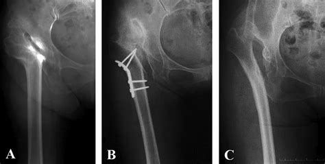 Total Hip Arthroplasty With Femoral Subtrochanteric Osteotomy After