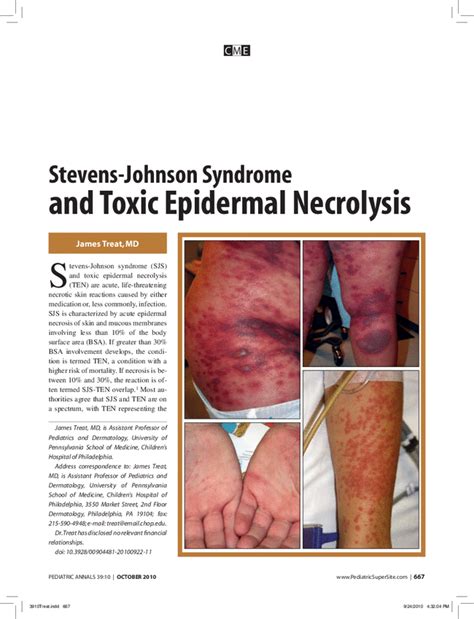 Stevens Johnson Syndrome And Toxic Epidermal Necrolysis Pediatric Annals
