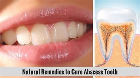 Natural Remedies To Cure Abscess Tooth
