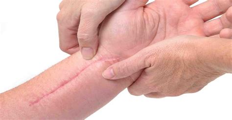 11 Exercises To Get Rid Of Scar Tissue Just Naturally Healthy