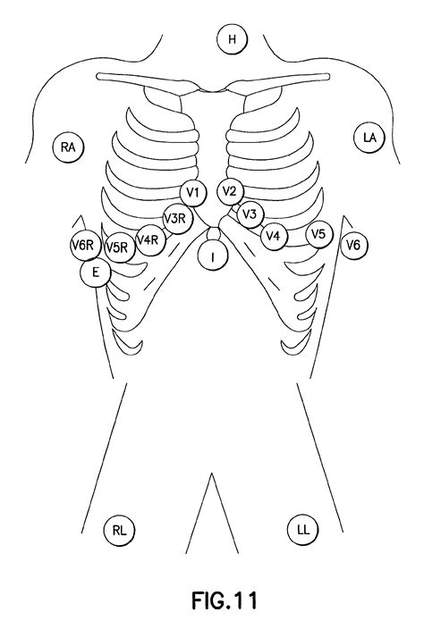 Pediatric Ekg 15 Lead Placement Diagram Diagram Back Muscles Gambaran