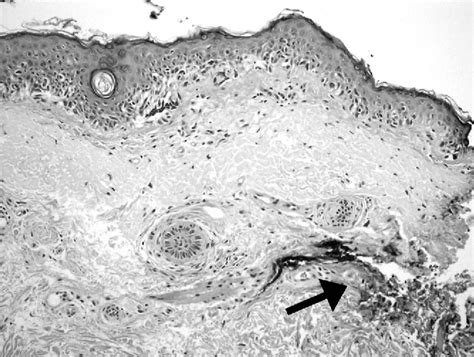 Figure 3 From Melanoma In Situ Treated With Topical Imiquimod For