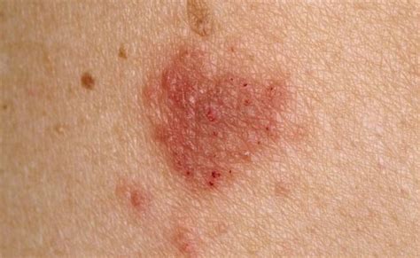 Severe Atopic Eczema Tied To Higher Cv Disease Risk Dermatology Advisor