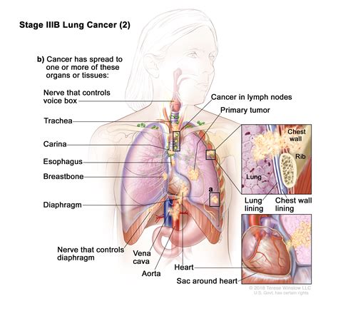 がん情報サイト がん情報各論： 医療専門家向け Non Small Cell Lung Cancer Treatment Pdq®
