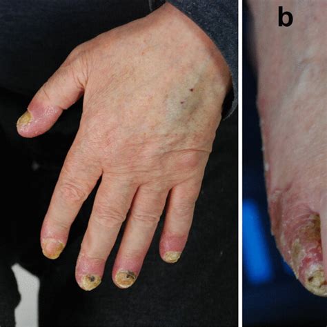 Acrodermatitis Continua Of Hallopeau Pustular Lesions Occupying The