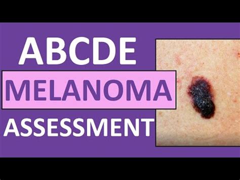 Descargar Dermatologists Explain The Abcde Melanoma Check Method