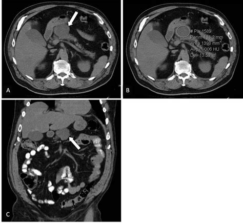 63 Year Old Male With A Dermoid Cyst Of The Pancreas Axial And
