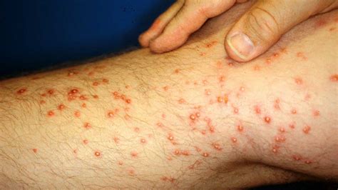 Vírus Ambicioso Dramático Red Bumps On Legs Faz Vagamente Cercado