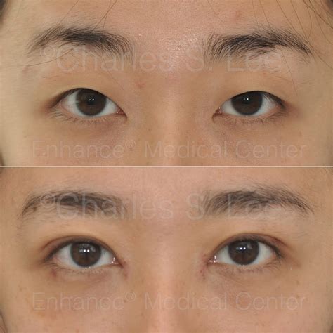 Asian Eyelid Surgery Dst Suture Method Charles S Lee Md