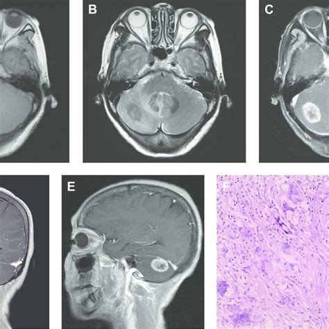 Pdf Cerebellar Cryptococcosis Characterized By A Space Occupying
