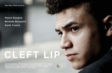 Cleft Lip 2018