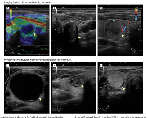 Figure 2 From The Diagnosis And Management Of Thyroid Nodules A Review