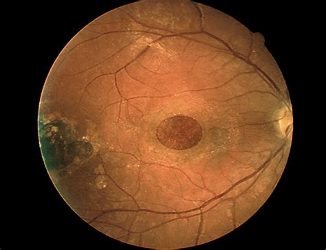 Giant Macular Hole As An Atypical Consequence Of A Toxoplasmic