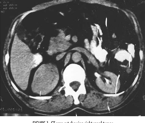 Figure 1 From Duodenal Metastasis From Renal Cell Carcinoma Presenting