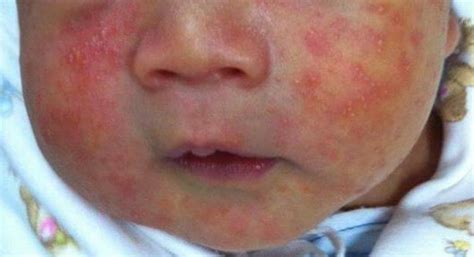 Baby Rash On Face Images