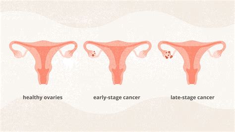 The Stages Of Ovarian Cancer And What They Mean