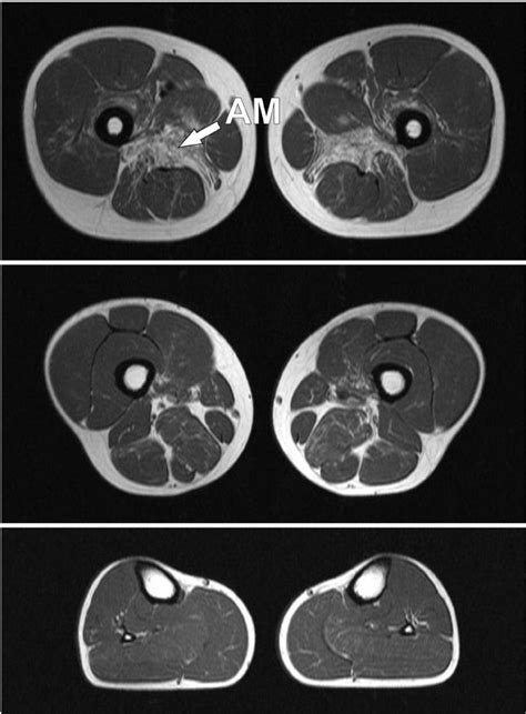 Transverse T1 Weighted Muscle Mri Images Of A Clinically Presymptomatic