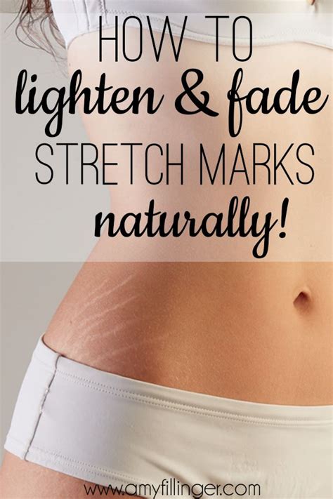 How To Remove Stretch Marks A Tried And Tested Way Stretch Marks