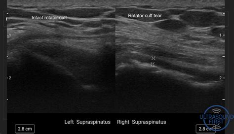 Supraspinatus Tear Ultrasound Sexiz Pix