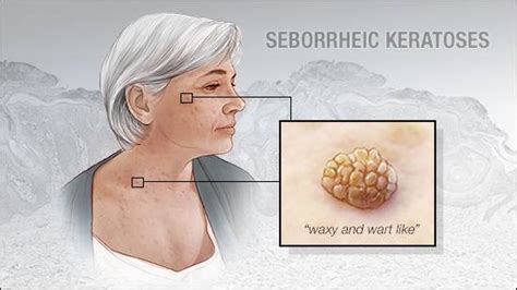 Mayo Clinic Q And A What Are Seborrheic Keratoses Mayo Clinic News