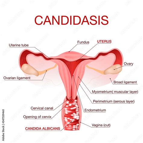 Vaginal Yeast Infection Candidiasis Gynecological Medical Disease The