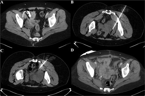 Long Term Experience With Percutaneous Biopsies Of Pelvic Lesions Using