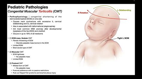 Torticollis → Mechanism Pathophysiology And Effects In Infants Youtube