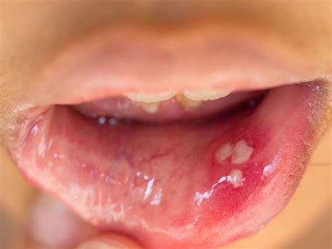 Human Papilloma Virus Signs And Symptoms Hpv Virus Symptoms Male My