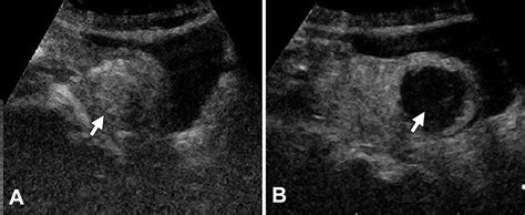 Uterine Leiomyomas Safety And Efficacy Of Us Guided Suprapubic