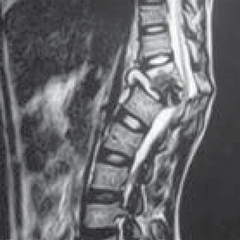 Cervical Tuberculous Osteomyelitis Managed Surgically Left Most Is