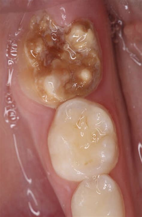 What Is Enamel Hypomineralisation Kiddies Dental Care