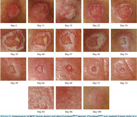 Pdf Treatment Of Skin Cancer With A Selective Apoptotic Inducing Curaderm Bec5 Topical Cream