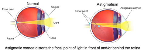 Astigmatism Diagrams Astigmatism Glaucoma Swollen Eyes Disease Fff