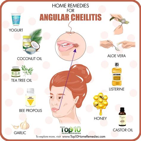 Home Remedies For Angular Cheilitis Cracked Corners Of Mouth Chapped