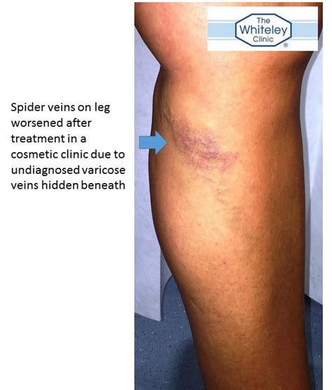 Spider Veins Of Legs Need Duplex Ultrasound Before Treatment