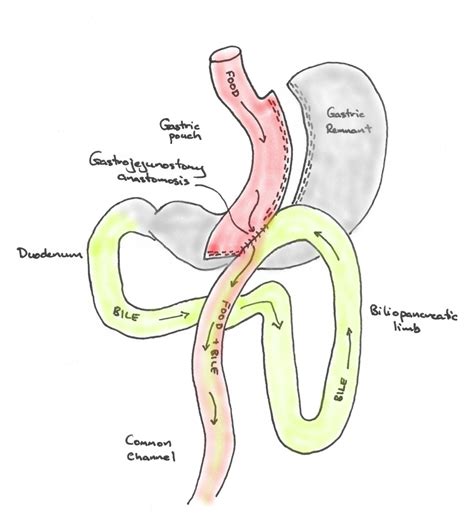 Revision One Anastomosis Gastric Bypass Consent