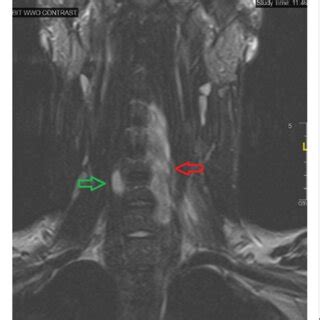 MRI Neck Soft Tissues With Contrast Showing Increased Signal Intensity