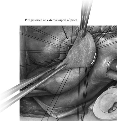 Aortic Root Enlargement In The Adult Operative Techniques In Thoracic