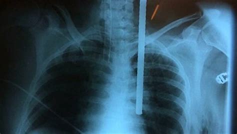 Peruvian Woman Survives Surgery After Being Impaled With Iron Bar