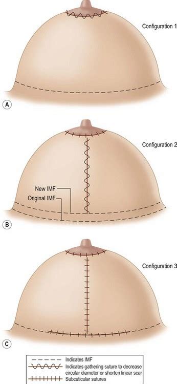 An Overview Of The Modern Era Of Breast Reduction Plastic Surgery Key