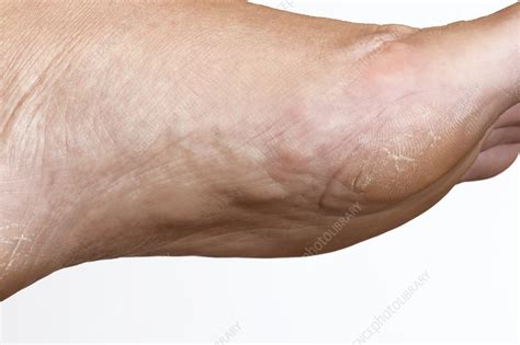 Fibromatosis Of The Foot Stock Image C0151663 Science Photo Library