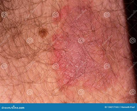 Fungal Infection On Skin Of Male Leg Stock Image Image Of Ringworm