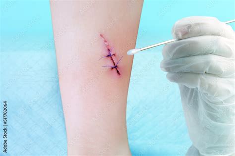 Fresh Sutured Wound On Childs Leg Wound Care In Hospital Non