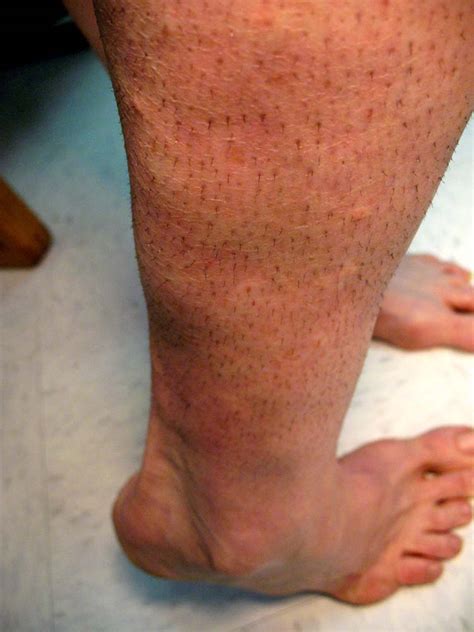 Photo Quiz Unusual Lumps To The Lower Leg With Fat Atrophy Of The
