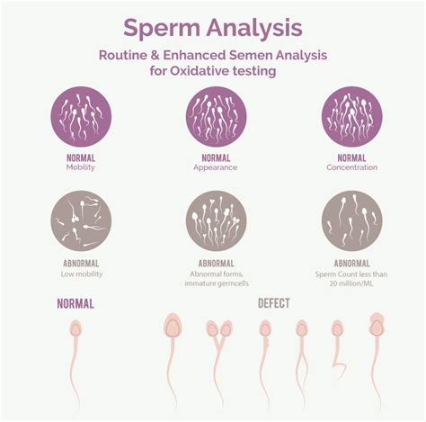 Sperm Analysis Looks In Detail At The Sperm Count And Mobility