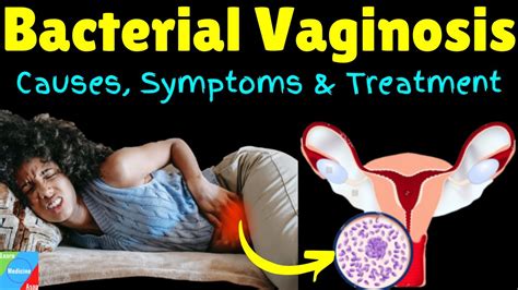 Bacterial Vaginosis Bv Symptoms Causes Diagnosis And Treatment