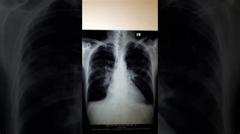 Pulmonary Edema X Ray Butterfly Pattern