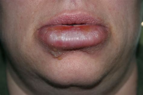 Do you get cold sores on the regular? cold sore on chin pictures - pictures, photos