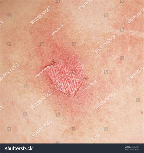 Macro Texture Of Burns On Human Skin Back Stock Photo 415678729